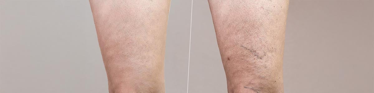 Apparition de varices avant apr&egrave;s