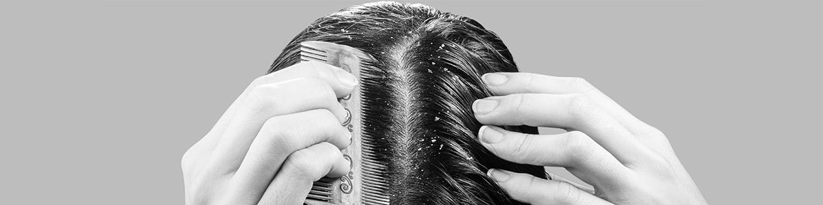 Dermatite s&eacute;borrh&eacute;ique cuir chevelu