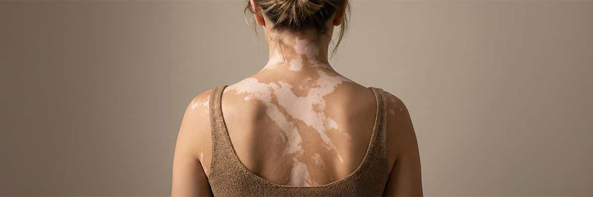 Tache blanche sur la peau : comprendre les causes et solutions