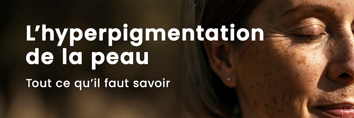 Hyperpigmentation : comprendre, prévenir et traiter les taches pigmentaires